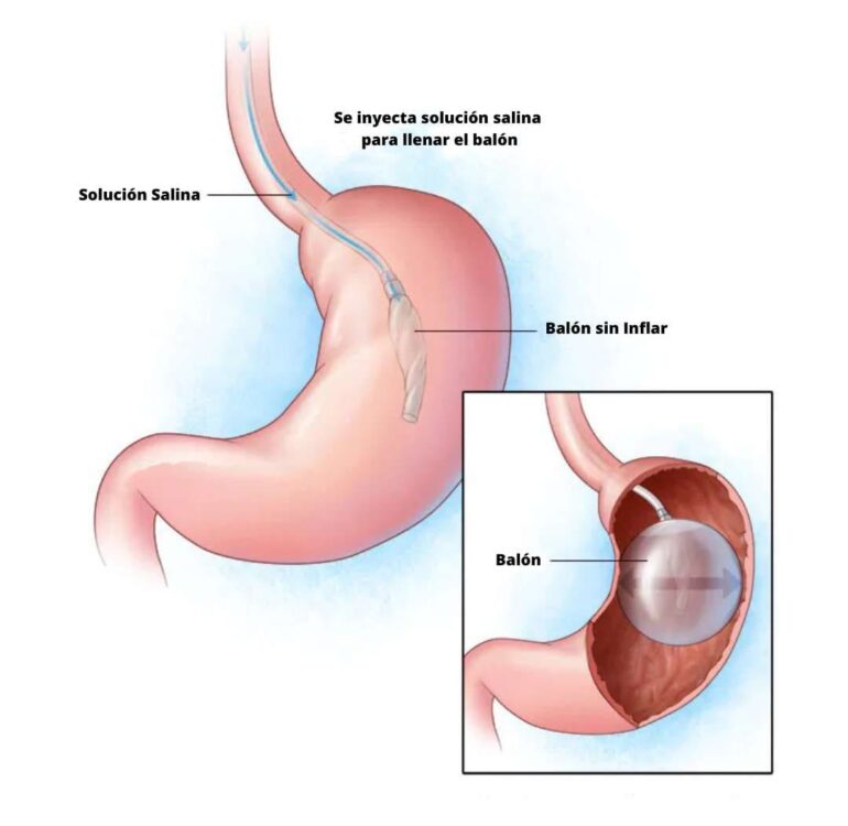 Balón Gástrico Ingerible en Bogotá