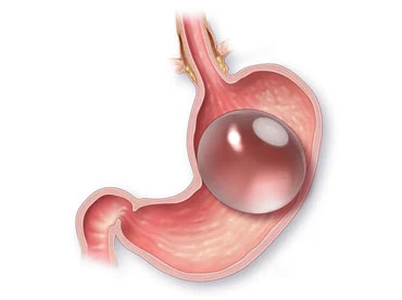 Tipos de Balón Gástrico - Global Obesity Group - Bogotá