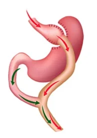 bypass gástrico con cirugía robótica