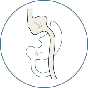 Gastric bypass (Roux-en-Y) diagram — Global Obesity Group