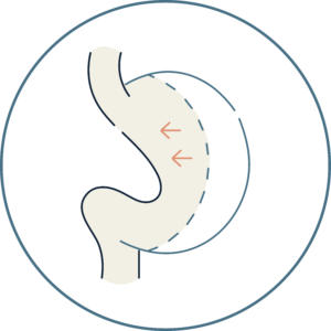 Gastric sleeve procedure diagram — Global Obesity Group