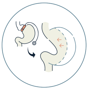 Bariatric revision surgery diagram — Global Obesity Group