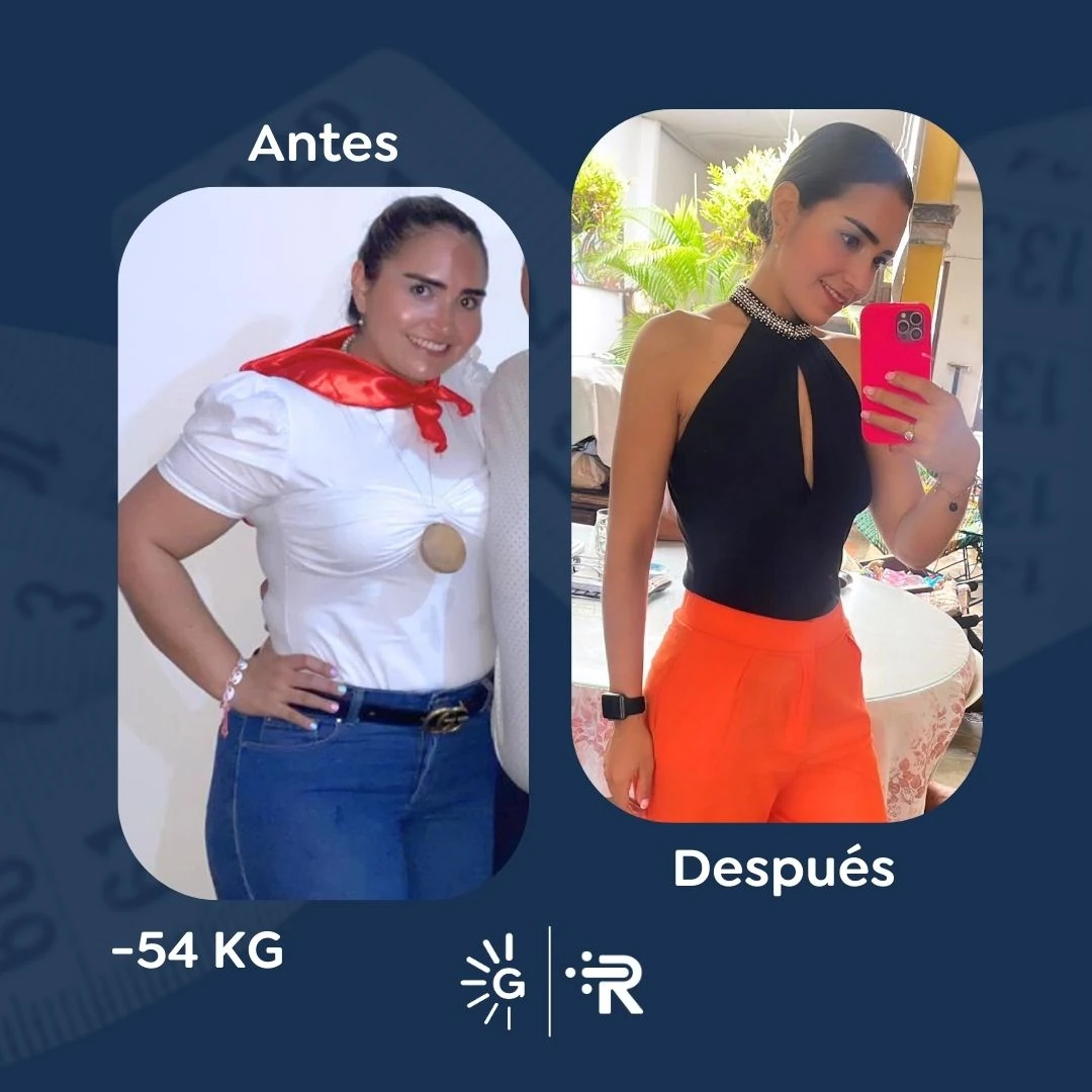 Before-and-after bariatric surgery result 6 — Dr. Rubén Luna, Global Obesity Group Bogotá