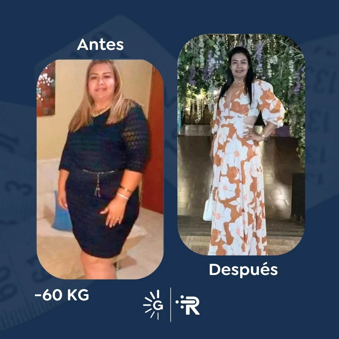 Before-and-after bariatric surgery result 5 — Dr. Rubén Luna, Global Obesity Group Bogotá