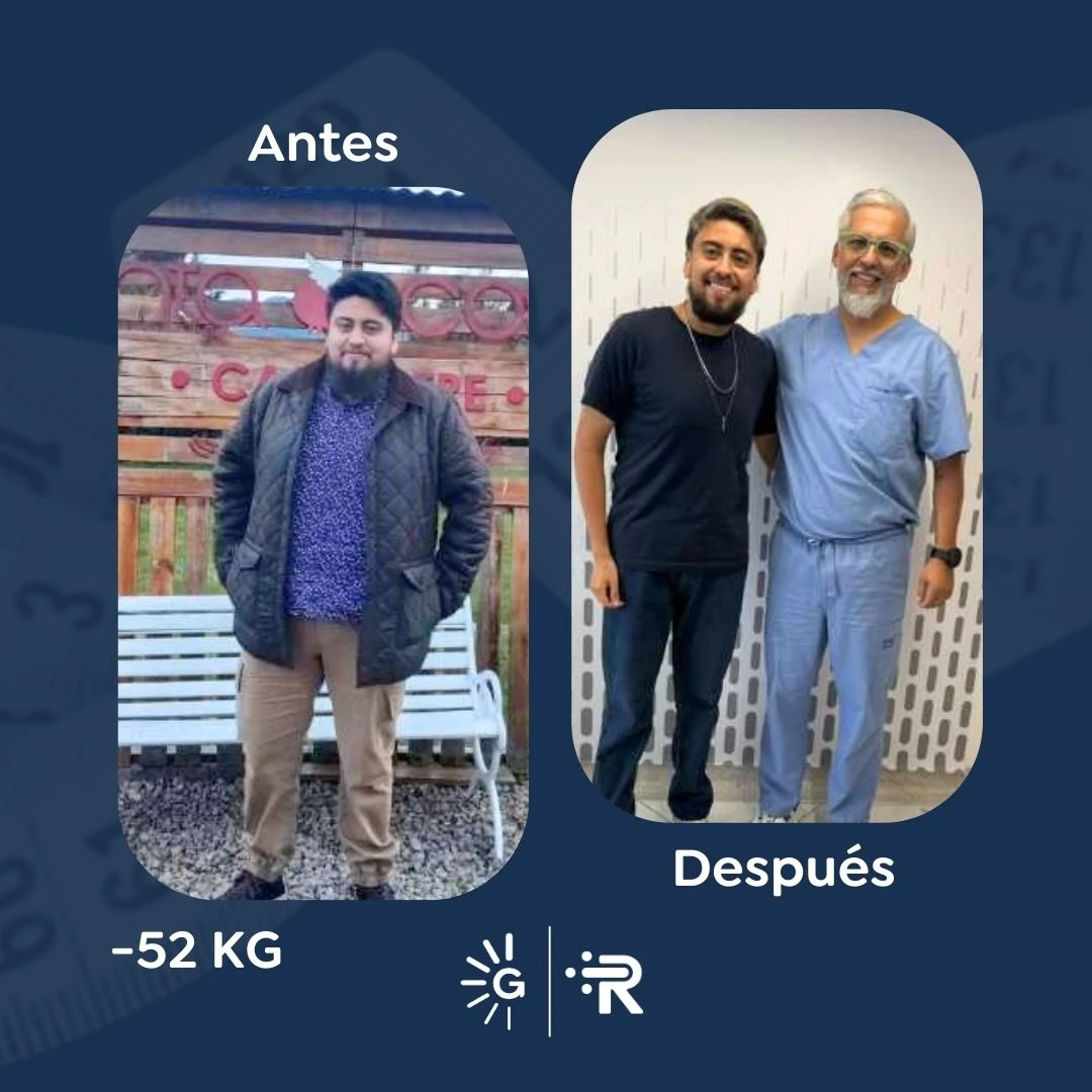 Before-and-after bariatric surgery result 4 — Dr. Rubén Luna, Global Obesity Group Bogotá
