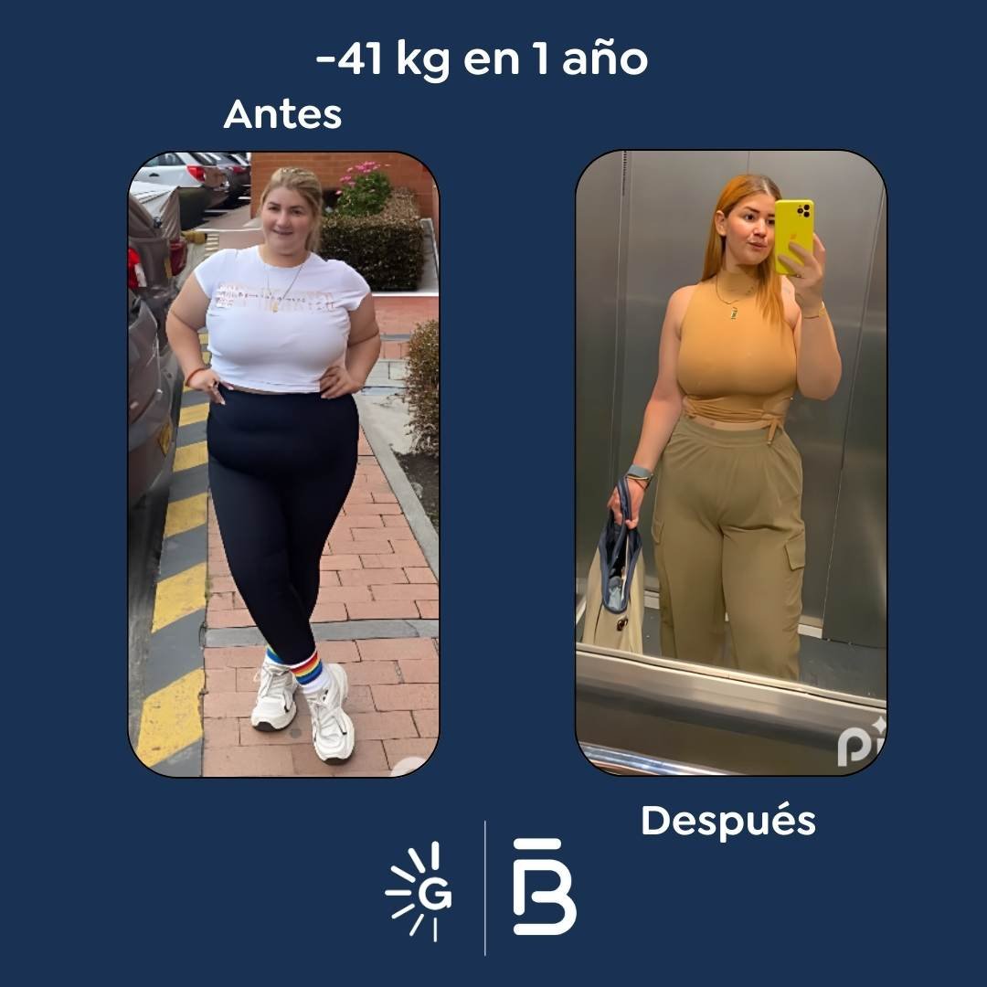 Antes y después cirugía bariátrica - Dr. Felipe Bernal 2