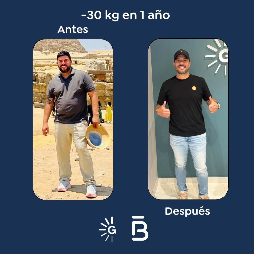 Antes y después cirugía bariátrica - Dr. Felipe Bernal