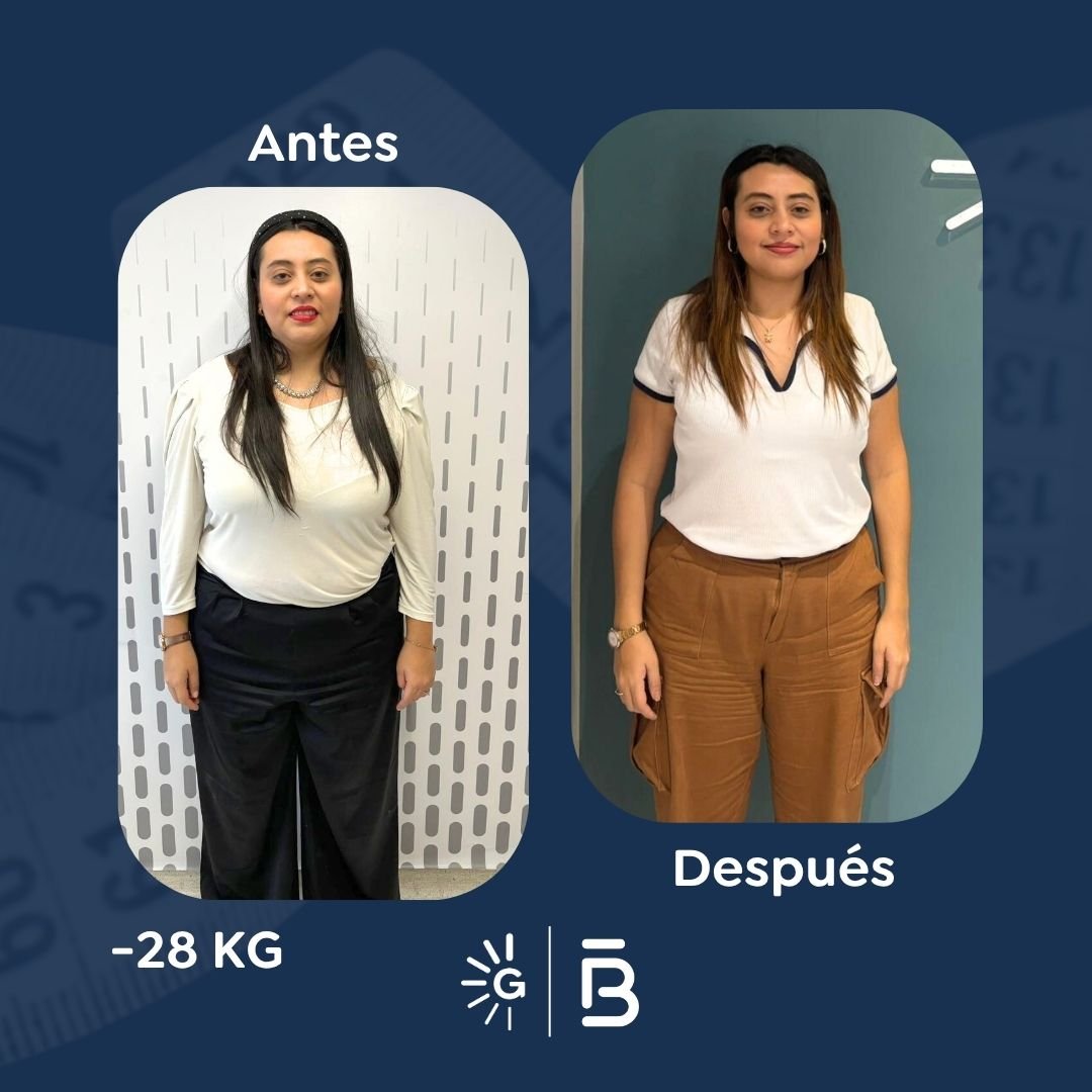 Antes y después de cirugía bariátrica en Bogotá con el Dr. Felipe Bernal - Global Obesity Group 011025 2