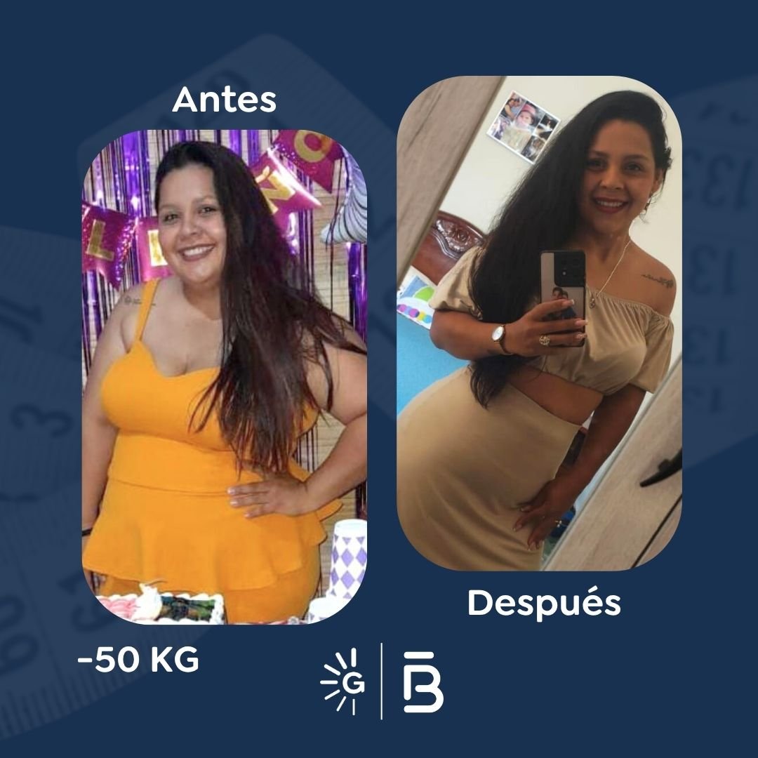 Antes y después de cirugía bariátrica en Bogotá con el Dr. Felipe Bernal - Global Obesity Group 011025 4