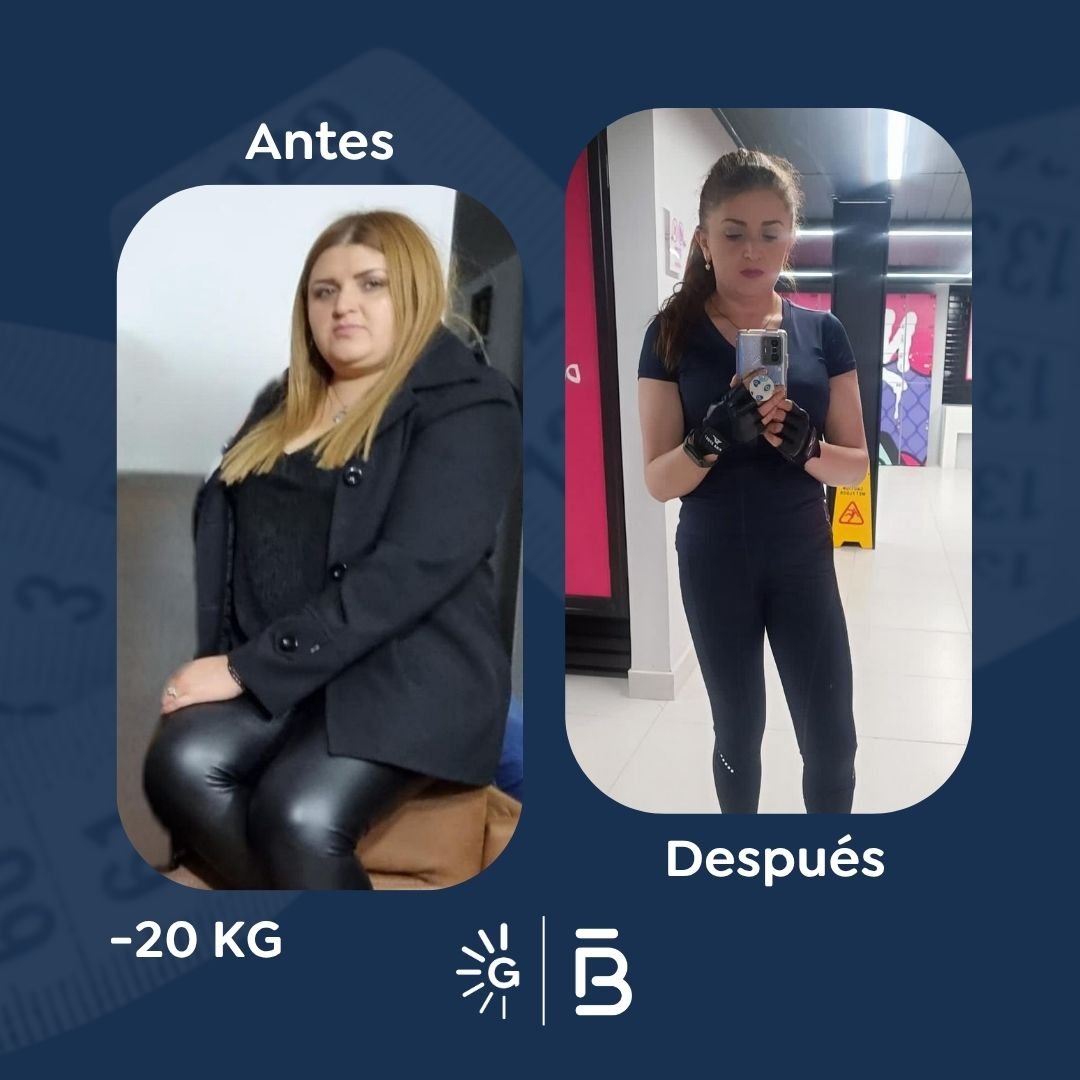 Antes y después de cirugía bariátrica en Bogotá con el Dr. Felipe Bernal - Global Obesity Group 011025