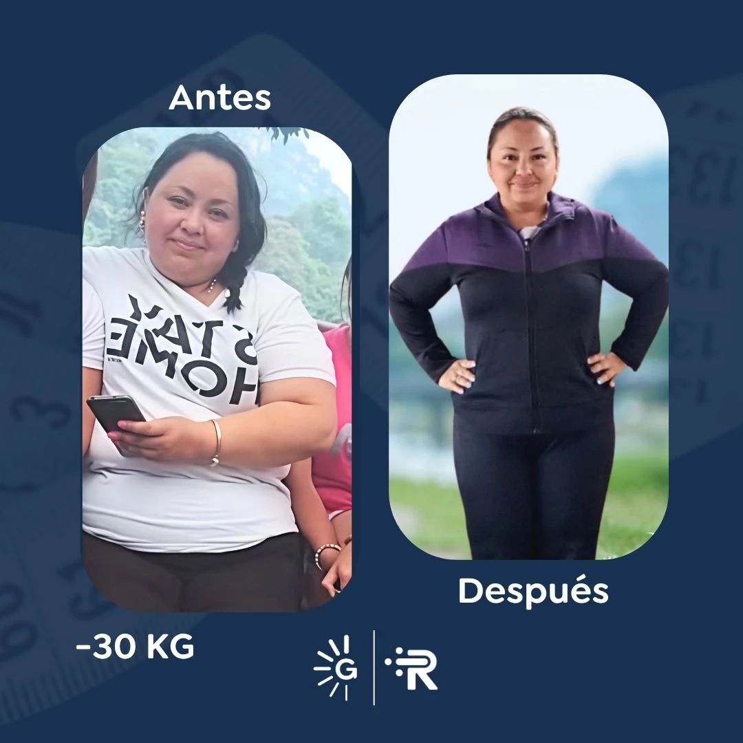 Before-and-after bariatric surgery result 3 — Dr. Rubén Luna, Global Obesity Group Bogotá