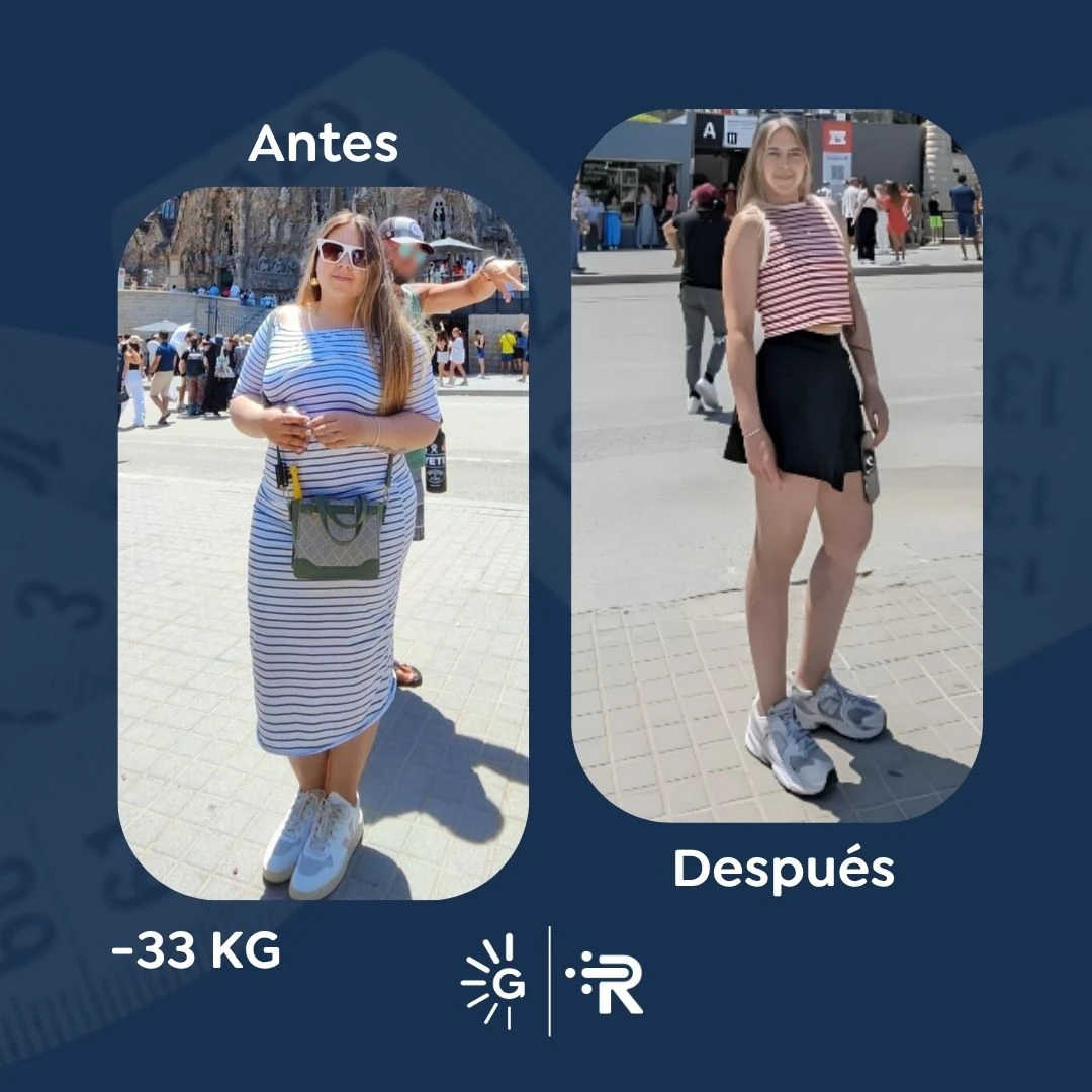 Before-and-after bariatric surgery result 2 — Dr. Rubén Luna, Global Obesity Group Bogotá