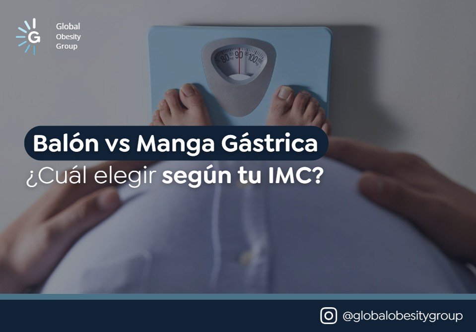 Balón vs Manga gástrica ¿cuál elegir?-Global Obesity Group