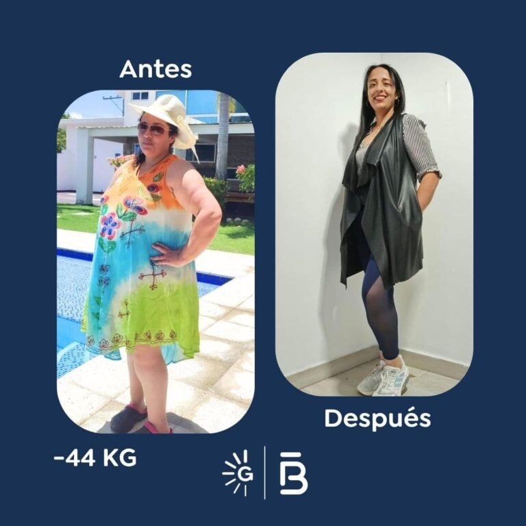 Antes y después de cirugía bariátrica en Bogotá con el Dr. Felipe Bernal - Global Obesity Group 041125 2