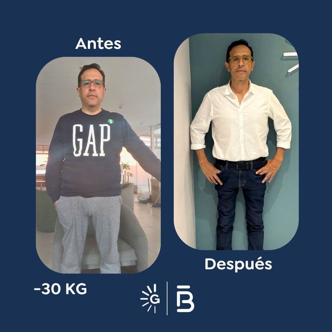 Antes y después de cirugía bariátrica en Bogotá con el Dr. Felipe Bernal - Global Obesity Group 041125
