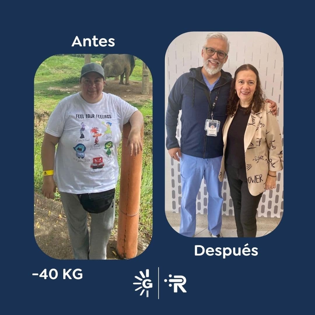 Antes y después de cirugía bariátrica en Bogotá con el Dr. Rubén Luna - Global Obesity Group 041125