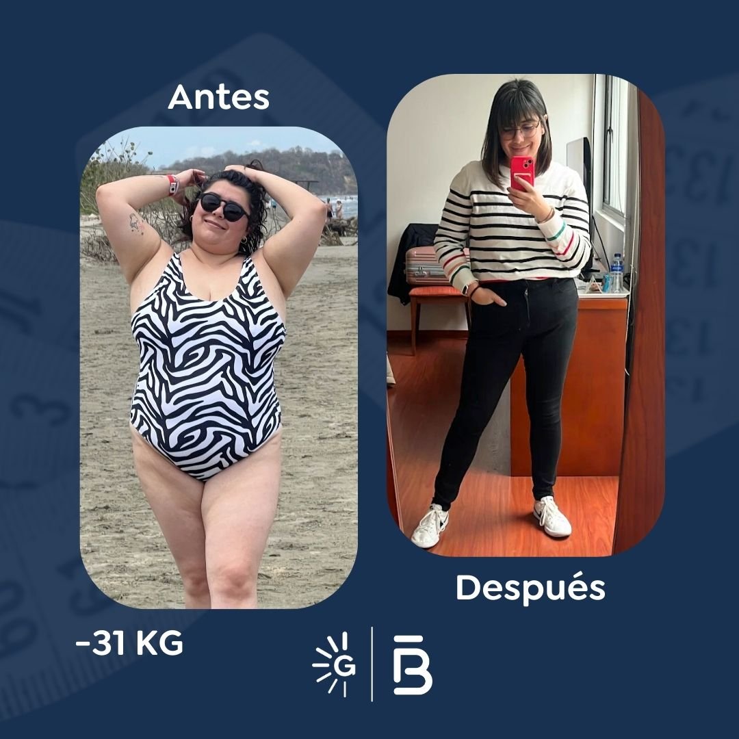 Antes y después de cirugía bariátrica en Bogotá con el Dr. Felipe Bernal - Global Obesity Group 011225 2