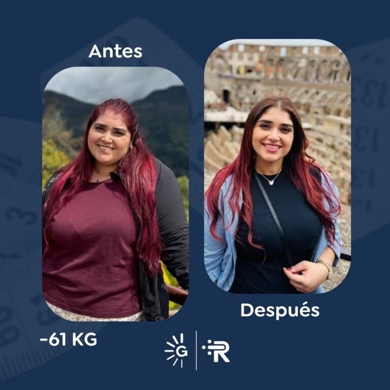 Antes y después de cirugía bariátrica en Bogotá con el Dr. Felipe Bernal - Global Obesity Group 011225