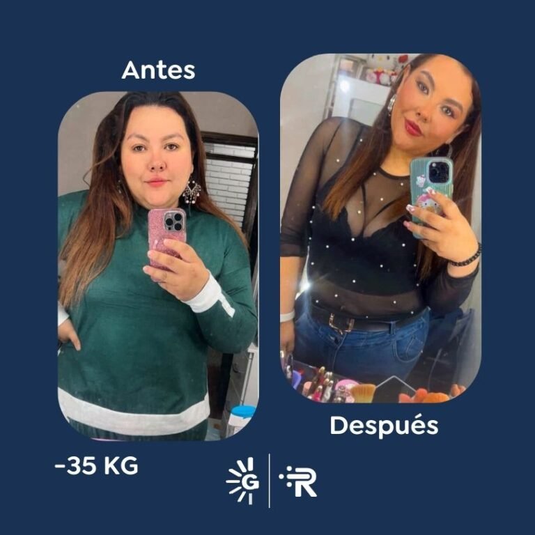 Antes y después de cirugía bariátrica en Bogotá con el Dr. Felipe Bernal - Global Obesity Group 011225