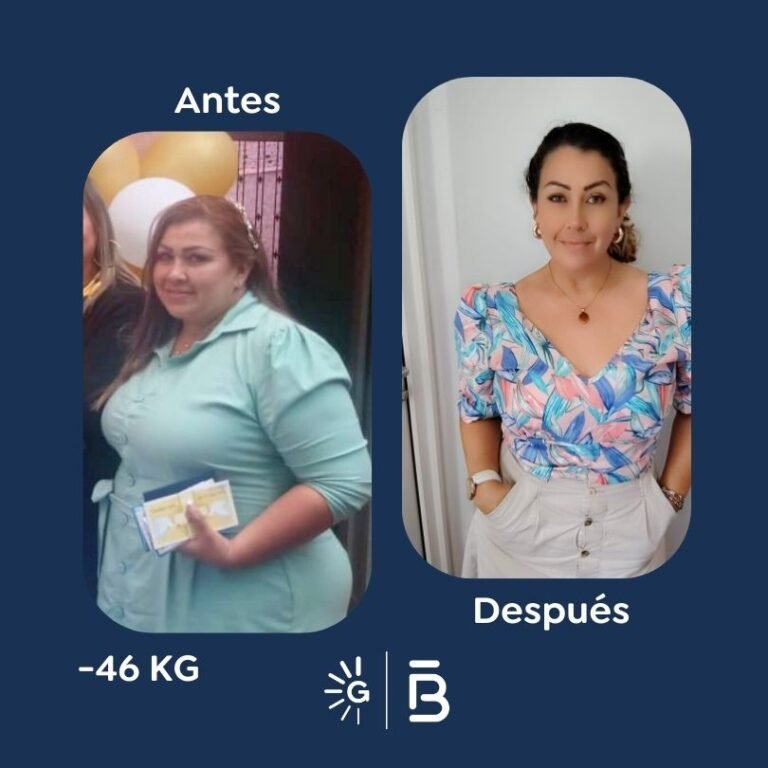 Antes y después Felipe Bernal para Global Obesity Group (GOG) (7)