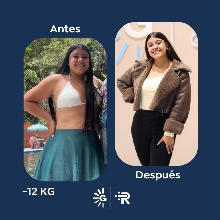 Antes y después de cirugía bariátrica en Bogotá con el Dr. Felipe Bernal - Global Obesity Group 011225