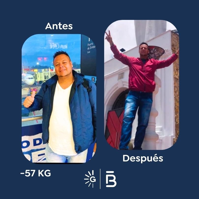 Antes y después Felipe Bernal para Global Obesity Group (GOG) (8)