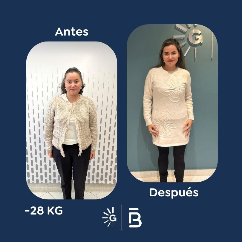 Antes y después Felipe Bernal para Global Obesity Group (GOG) (9)