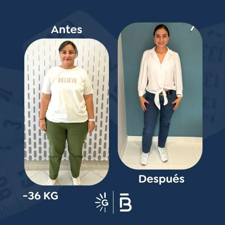 Bariatric surgery before-and-after case with Dr. Felipe Bernal at Global Obesity Group Bogotá Colombia