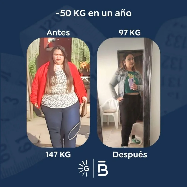 Bariatric surgery before-and-after case with Dr. Felipe Bernal at Global Obesity Group Bogotá Colombia