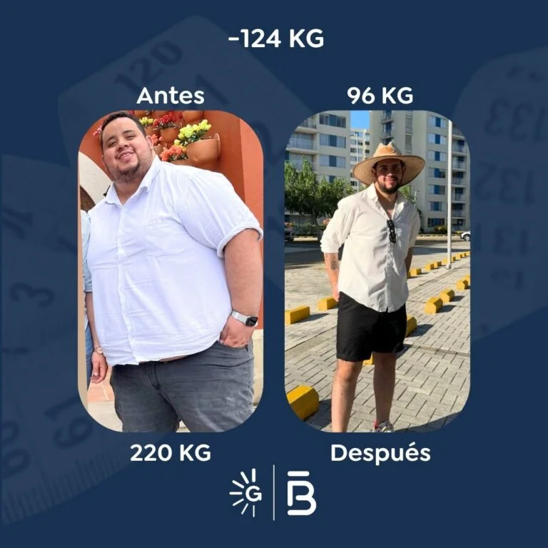 Bariatric surgery before-and-after case with Dr. Felipe Bernal at Global Obesity Group Bogotá Colombia