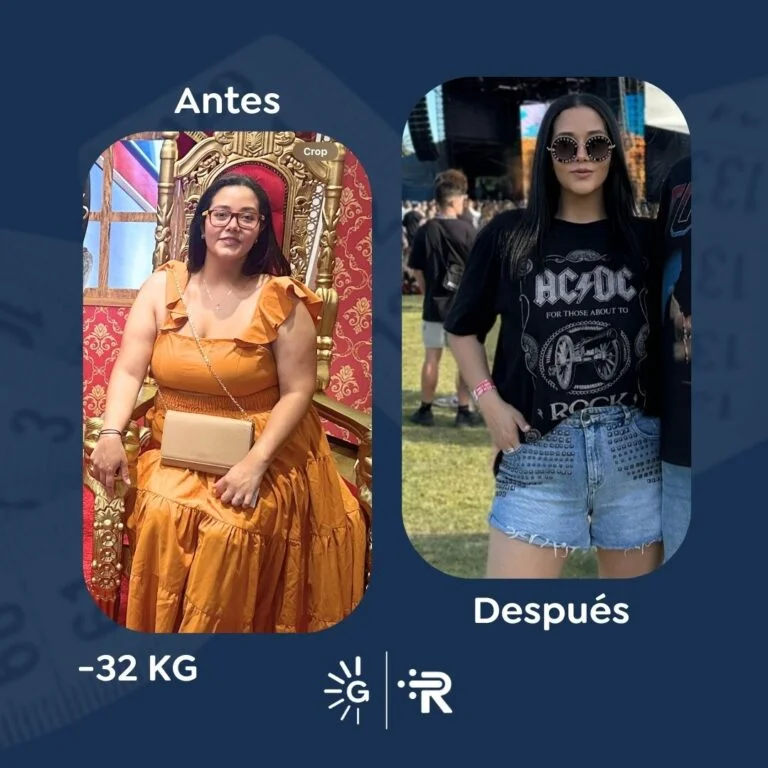 Bariatric surgery before-and-after case with Dr. Rubén Luna at Global Obesity Group Bogotá Colombia