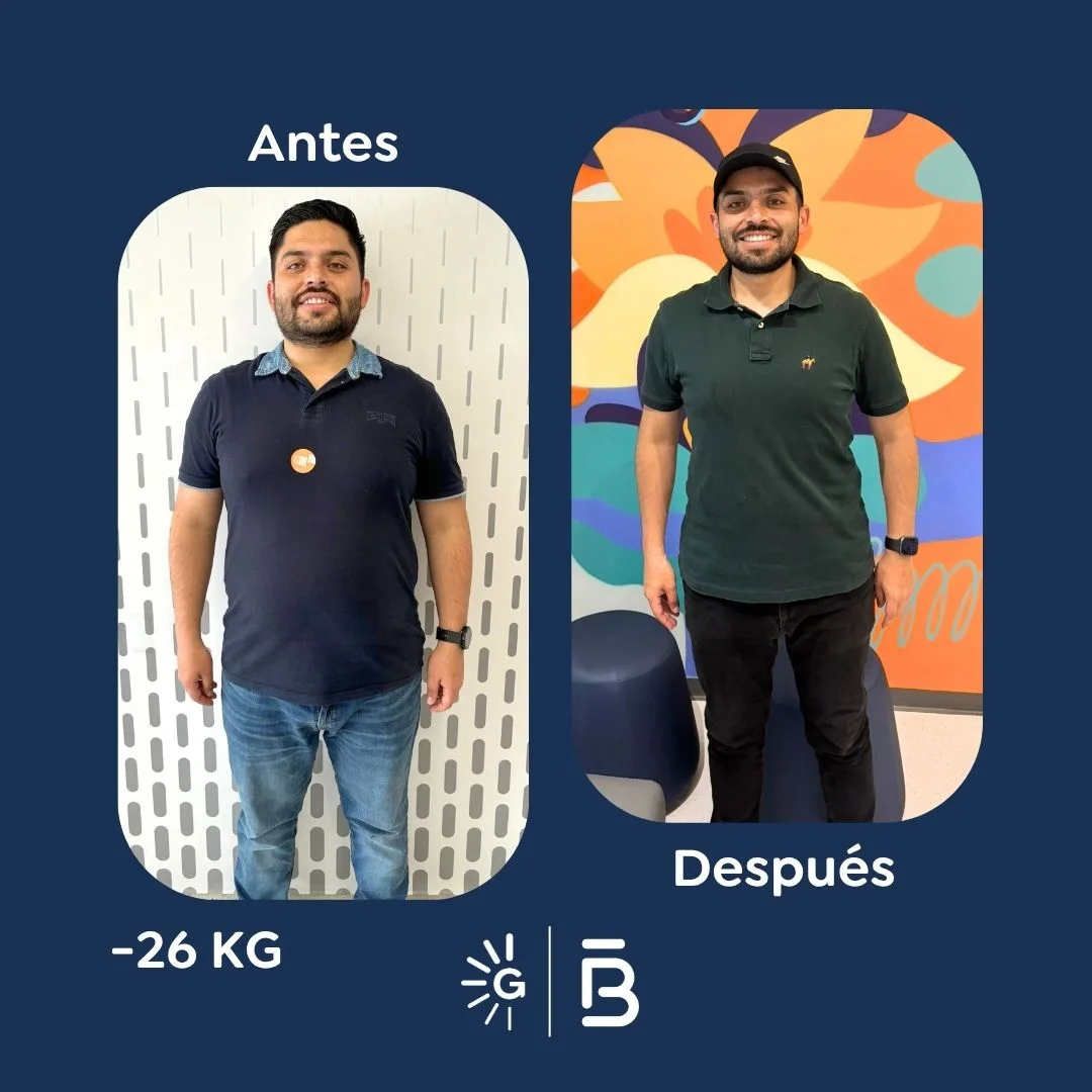 Antes y después de la Cirugía Bariátrica con el Dr. Felipe Bernal en Global Obesity Group - Bog-Col