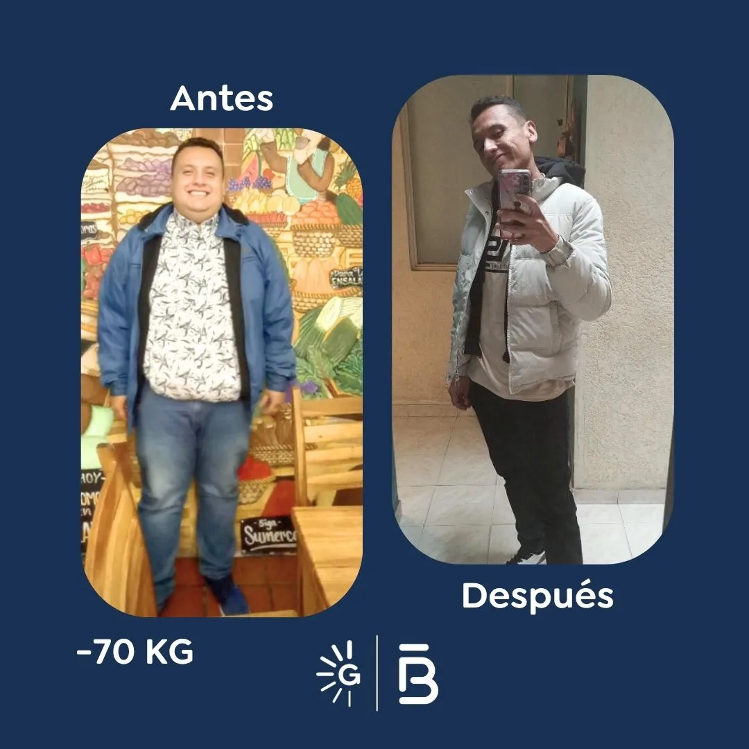 Antes y después de la Cirugía Bariátrica con el Dr. Felipe Bernal en Global Obesity Group - Bogotá