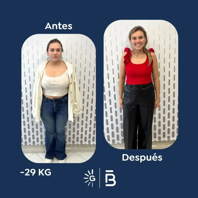 Antes y después de la Cirugía Bariátrica con el Dr. Felipe Bernal en Global Obesity Group - Colombia