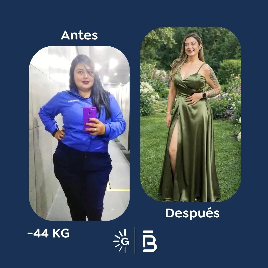 Antes y después de la Cirugía Bariátrica con el Dr. Felipe Bernal en Global Obesity Group - GOG