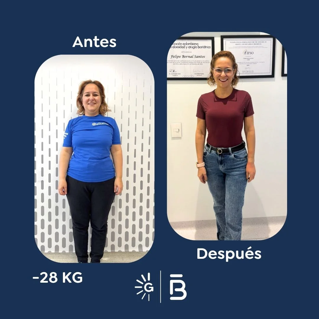 Antes y después de la Cirugía Bariátrica con el Dr. Felipe Bernal en Global Obesity Group