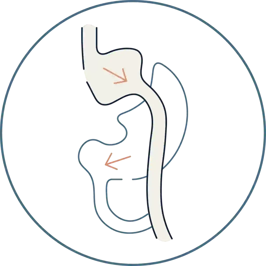 Bypass gástrica- Cirugía Metabólica- Global Obesity Group