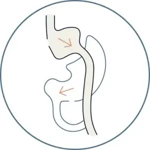 programas para bajar de peso - Bypass-gastrica-Cirugia-Metabolica-Global-Obesity-Group