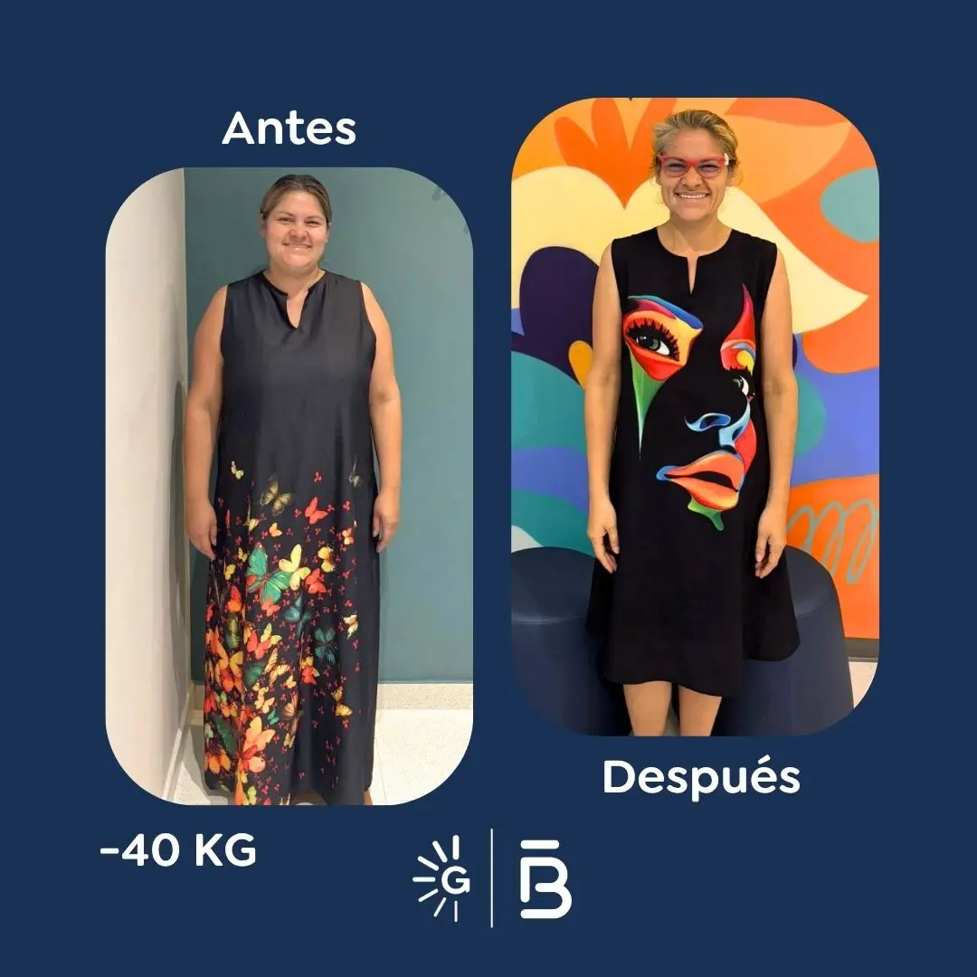 Cirugía bariátrica antes y después en Bogotá, Colombia - Global Obesity Group - Dr. Felipe Bernal - Manga gástrica - Bypass gástrico 03082026 1