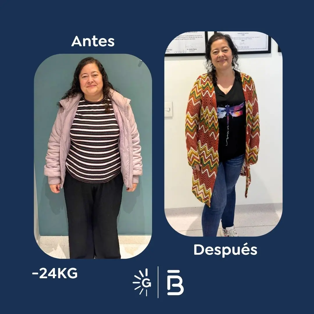 Cirugía bariátrica antes y después en Bogotá, Colombia - Global Obesity Group - Dr. Felipe Bernal - Manga gástrica - Bypass gástrico 03082026 2