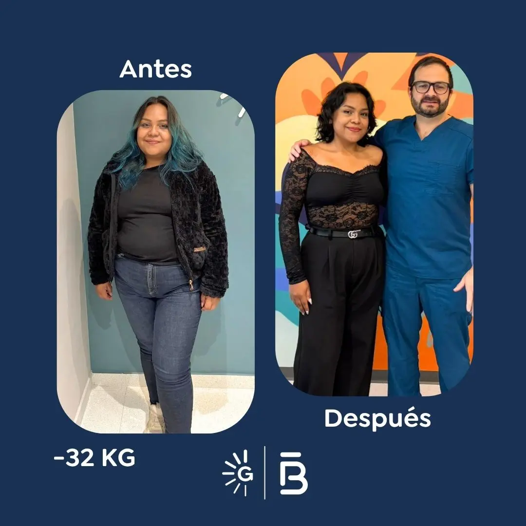 Cirugía bariátrica antes y después en Bogotá, Colombia - Global Obesity Group - Dr. Felipe Bernal - Manga gástrica - Bypass gástrico 03082026 3