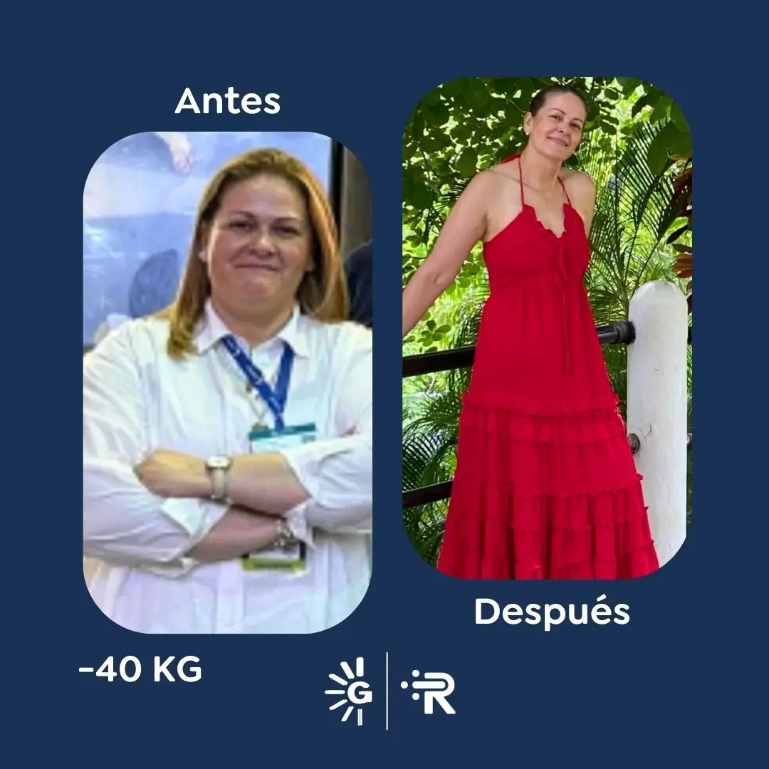 Cirugía bariátrica antes y después en Bogotá, Colombia - Global Obesity Group - Dr. Rubén Luna - Manga gástrica - Bypass gástrico 03082026