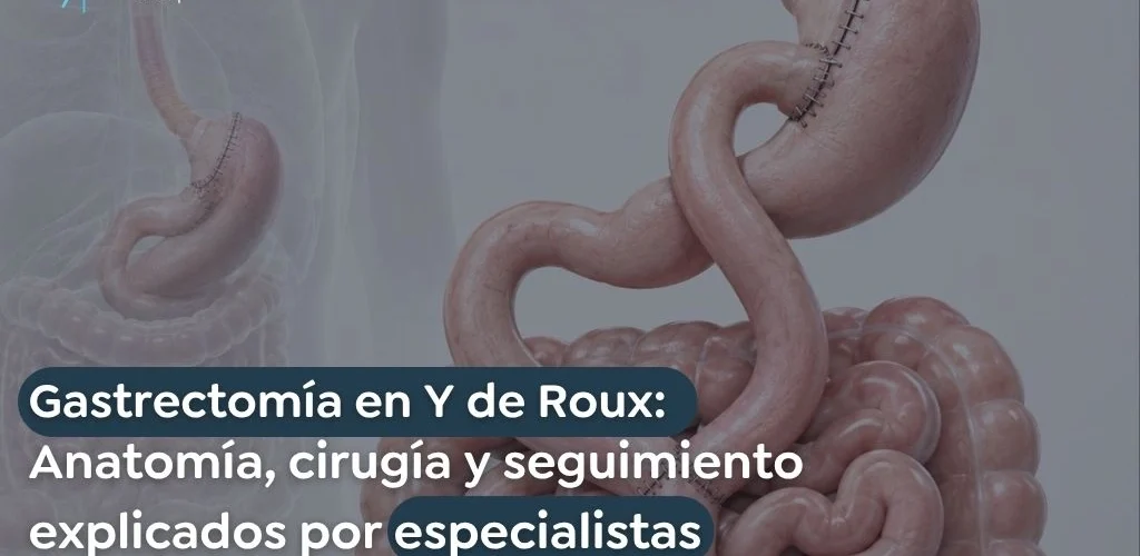 Gastrectomía en Y de Roux Anatomía cirugía y seguimiento explicados por especialistas - Global Obesity Group