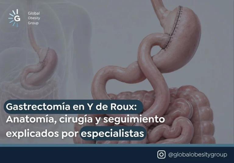 Gastrectomía en Y de Roux Anatomía cirugía y seguimiento explicados por especialistas - Global Obesity Group