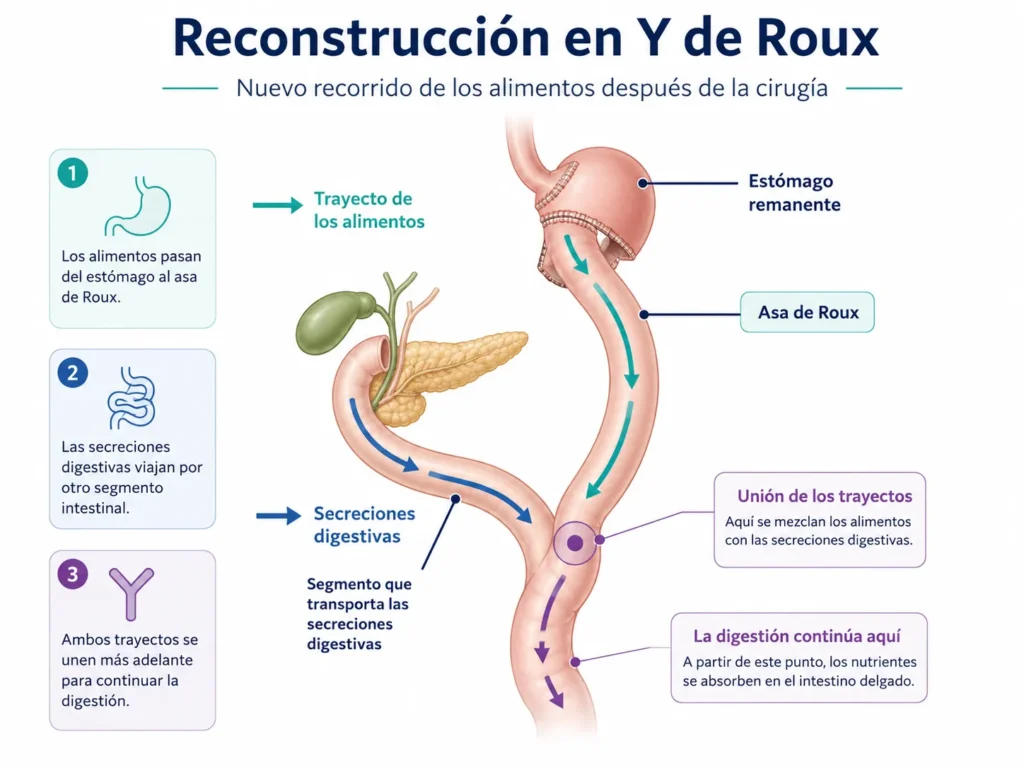 gastrectomía en y de roux - Global obesity group