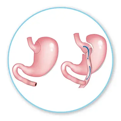 Laparoscopia avanzada Bogota- Global Obesity Group